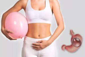 Gastric Balloon Placement in Dubai