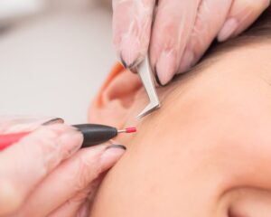 Electrolysis Laser Hair Removal in Dubai