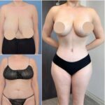 How to Identify the Best Tummy Tuck Surgeon in dubai