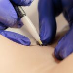 What Is Electrolysis Laser Hair Removal