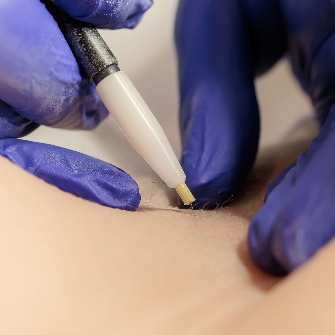 What Is Electrolysis Laser Hair Removal