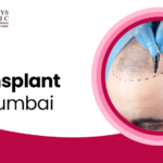 Addressing the Common Hair Transplant Issues 