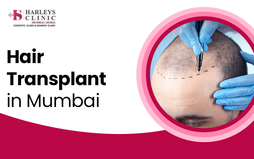 Addressing the Common Hair Transplant Issues