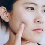 What to Expect From Acne Treatment Dubai