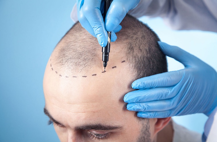 Regrow Hair Easily With Best Hair Transplant in Kerala