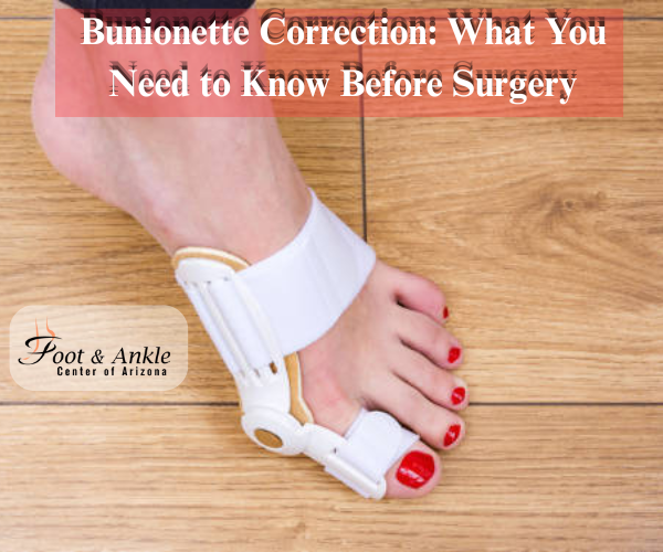 Bunionette Correction: What You Need to Know Before Surgery
