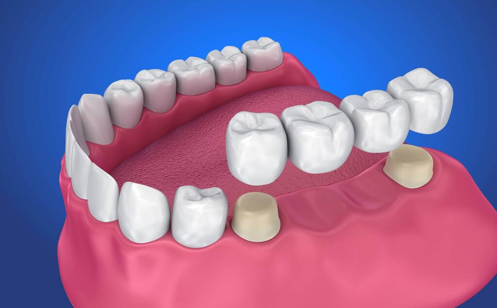 Dental Crowns and Bridges Overview