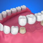 Dental Crowns and Bridges Overview