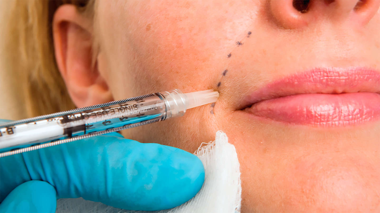 Is Arnica Good After Lip Fillers Injections?