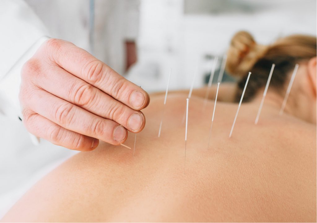 Unlock Pain Relief Techniques with Dry Needling CPD Training