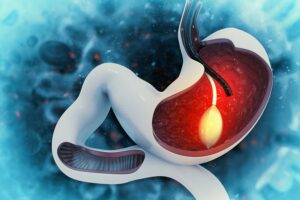 Gastric Balloon Placement in Dubai