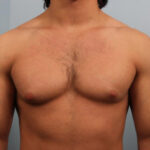 How Does Age Affect the Severity of Gynecomastia?