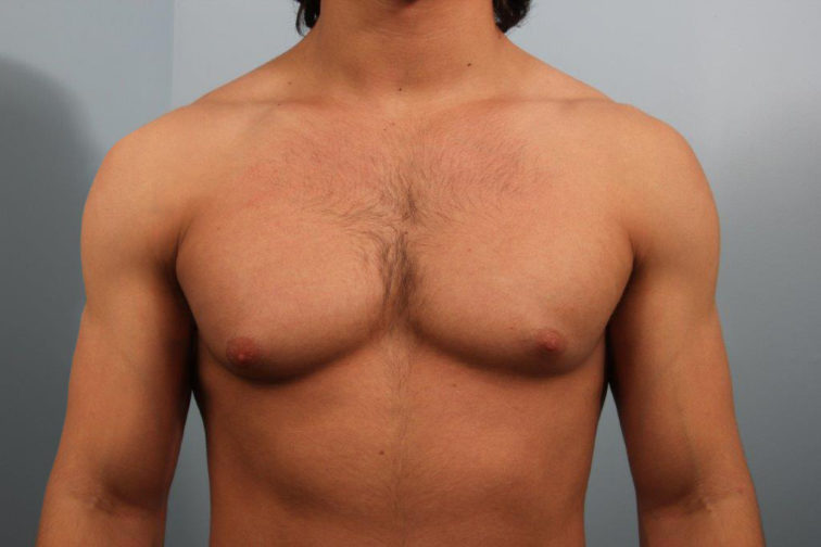 How Does Age Affect the Severity of Gynecomastia?