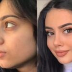 Precision and Beauty: Best Rhinoplasty Surgeons in Dubai