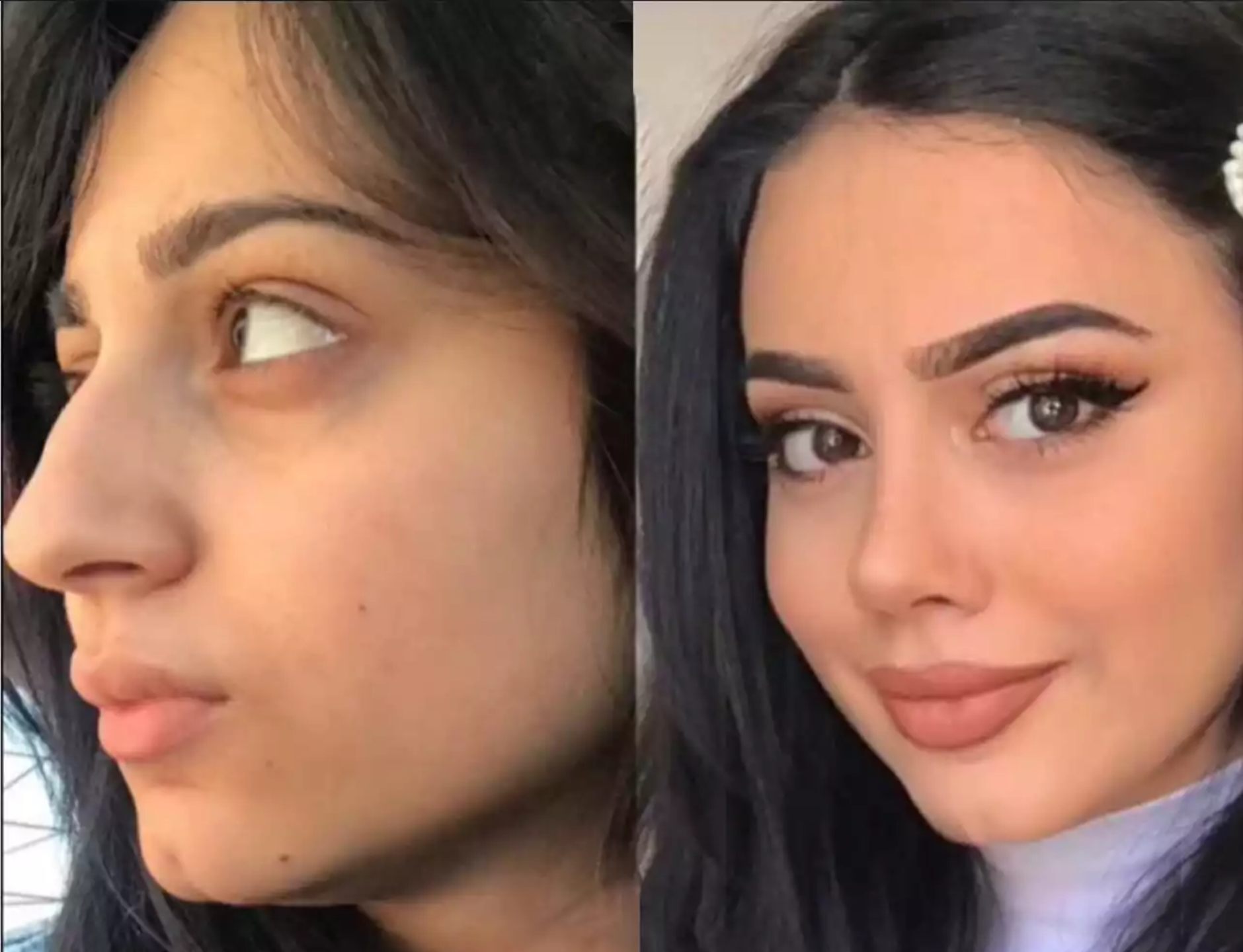 Precision and Beauty: Best Rhinoplasty Surgeons in Dubai