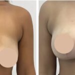 Is Breast Reduction Surgery in dubai Safe? Insights from Experts