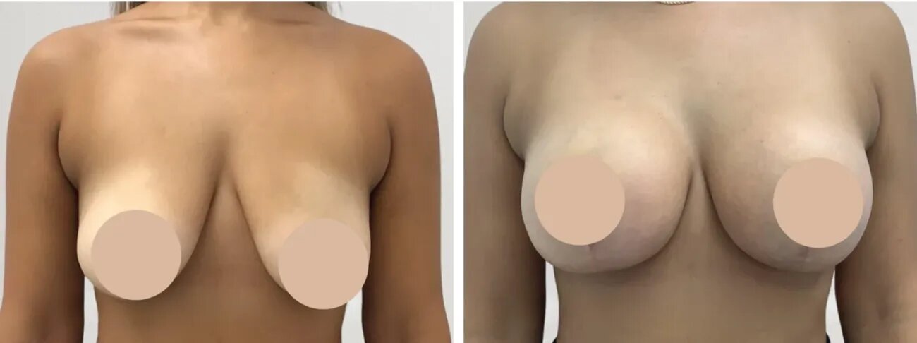 Is Breast Reduction Surgery in dubai Safe? Insights from Experts
