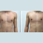 Why You Should Choose the Best Gynecomastia Surgeon in dubai