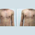 Understanding the Connection Between Hormones and Gynecomastia Surgery in dubai