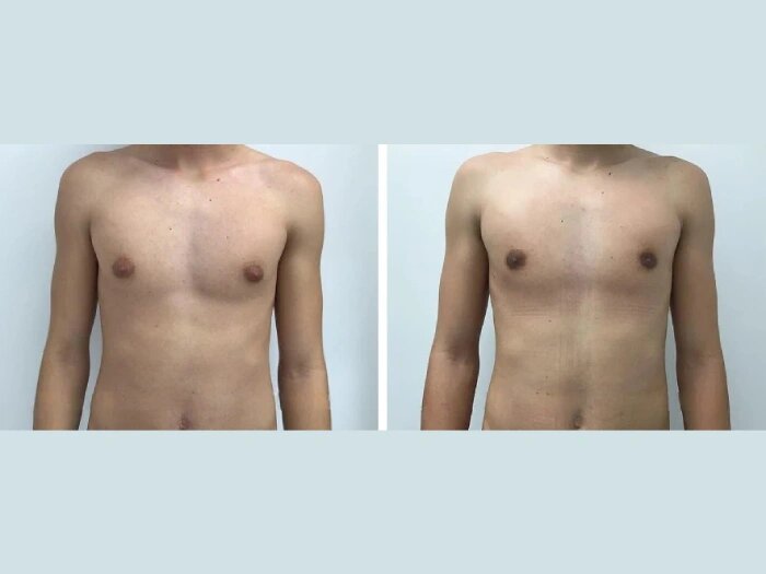 Understanding the Connection Between Hormones and Gynecomastia Surgery in dubai