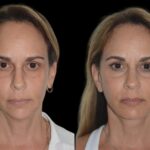 Chin Fillers in Dubai: Best Doctors in dubai for a Perfect Chin