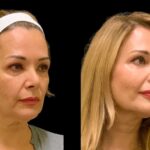 The Most Popular Cheek Fillers Brands at the Best Aesthetic Clinics in Dubai