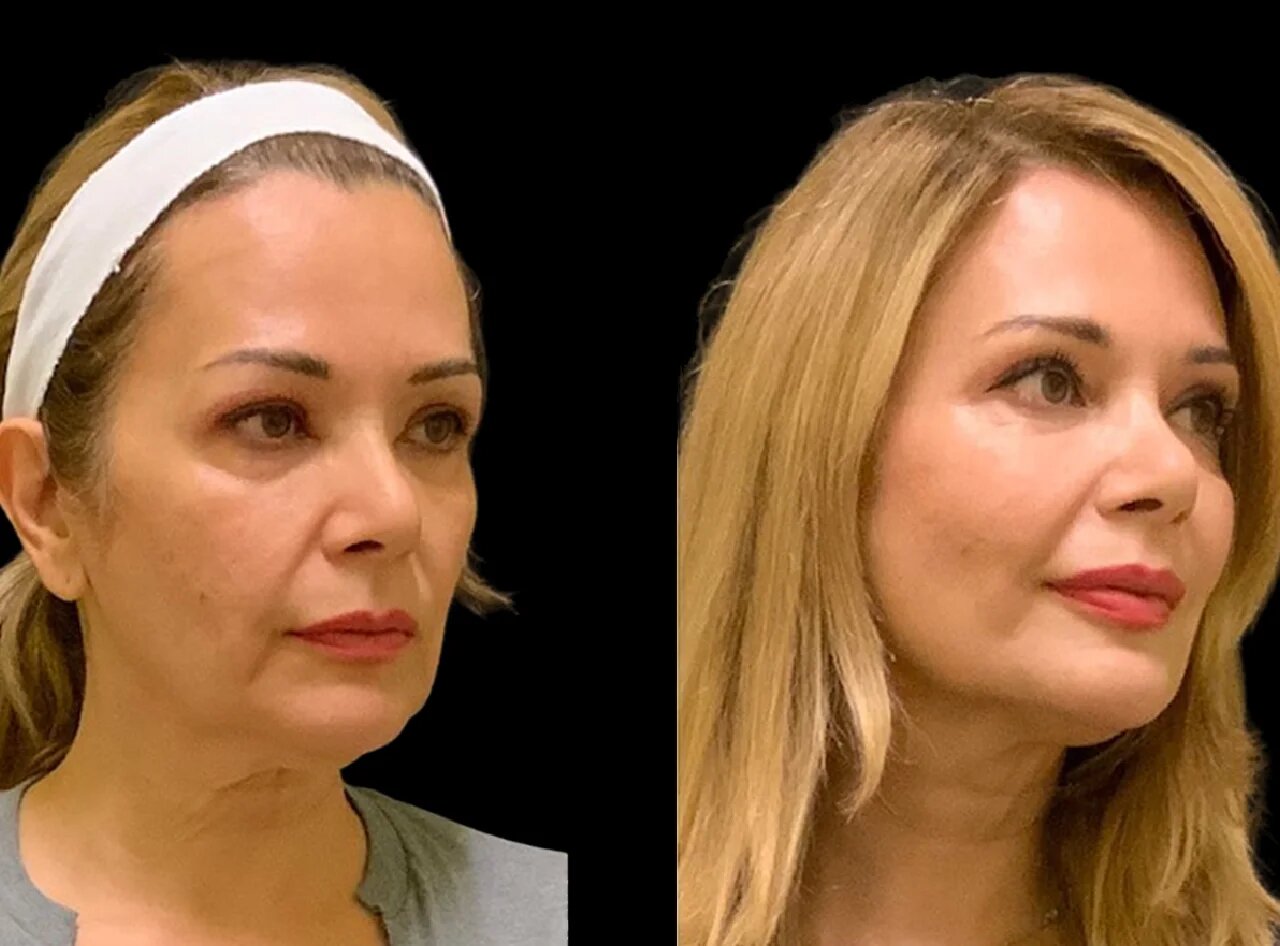 The Most Popular Cheek Fillers Brands at the Best Aesthetic Clinics in Dubai