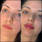 Choosing Between Fillers and Surgery: Advice from the Best Doctors in dubai