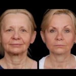 Best Aesthetic Clinics in Dubai: Your Guide to Under Eye Fillers
