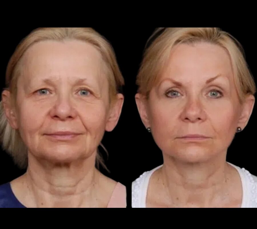 Best Aesthetic Clinics in Dubai: Your Guide to Under Eye Fillers