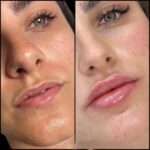Best Aesthetic Clinic in dubai for Fillers: Youthful Skin Awaits