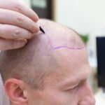 How Does A Hair Transplant Work?