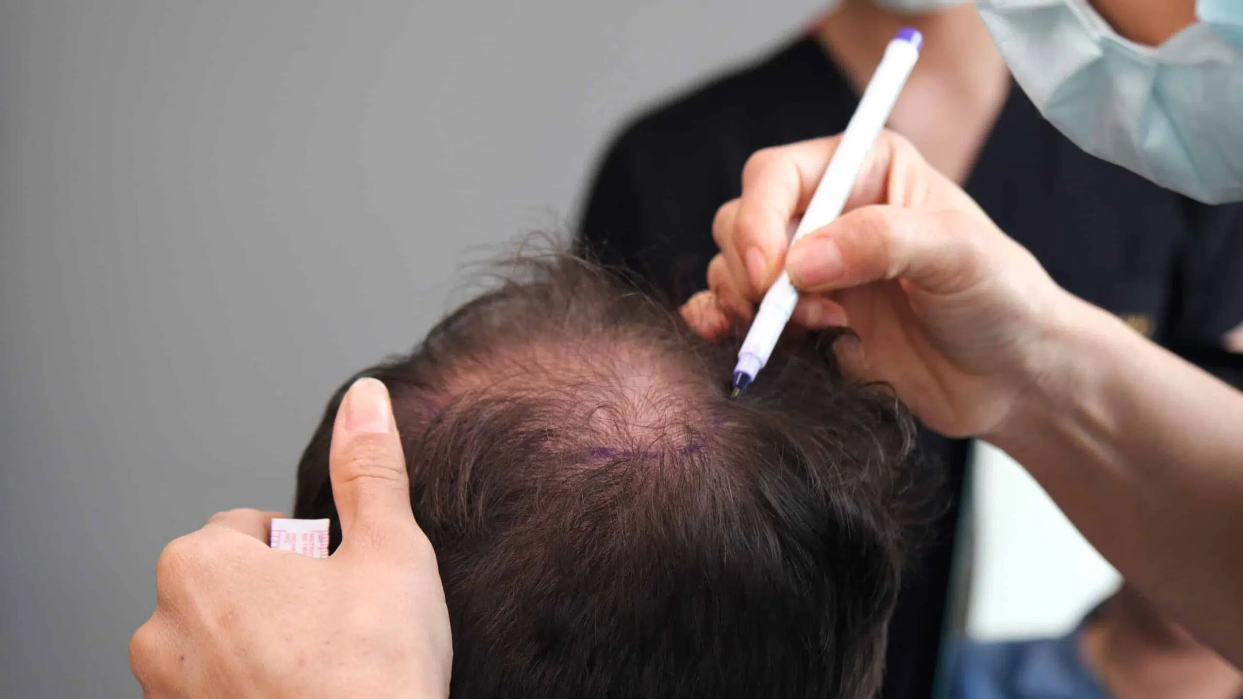 Hair Transplant in Dubai