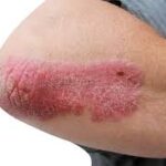 How Can You Prevent Fungal Infections During Dubai’s Humid Months