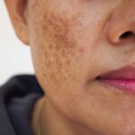 Best Melasma Treatment to Reveal Clearer Radiance