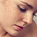Why Is Melasma Treatment So Effective?
