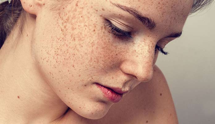 Why Is Melasma Treatment So Effective?