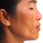 Top-Rated Melasma Skin Treatments