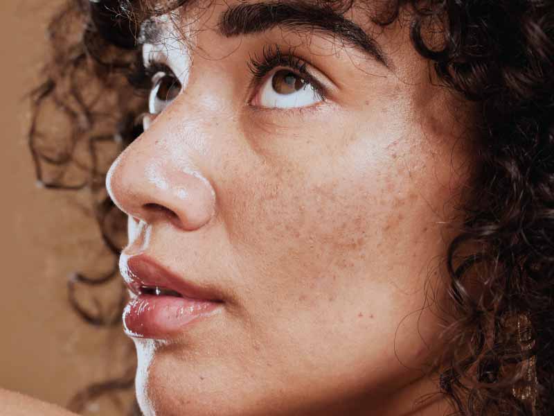 Melasma Treatment: What Really Works?