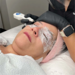 Plasma Pen Treatment: Causes of Eye Bag Puffiness
