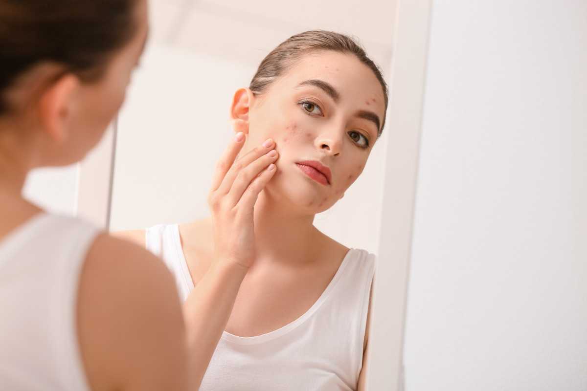 Does Smoking Weed Cause Acne: Myths vs. Facts