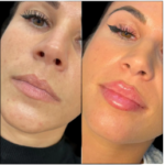 The Rising Demand for Fillers in Dubai