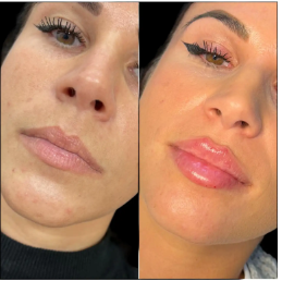 The Rising Demand for Fillers in Dubai