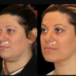 What Is the Consultation Process Like with the Best Doctors in Dubai for Sculptra Fillers?