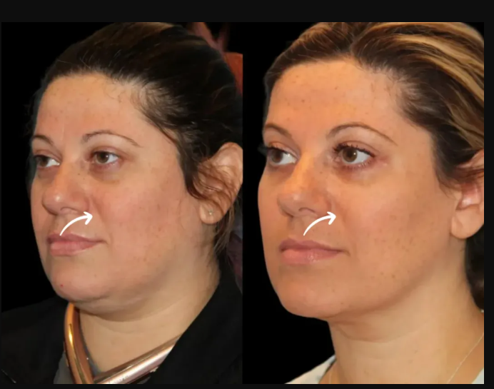 What Is the Consultation Process Like with the Best Doctors in Dubai for Sculptra Fillers?