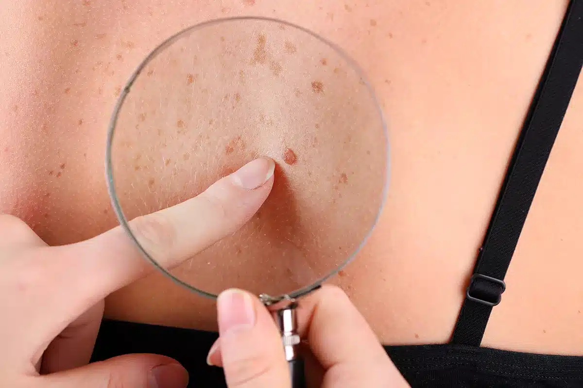 How to Safely Remove Skin Tags : Tips and Precautions