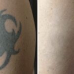 What Makes Enlighten by CUTERA Different from Other Laser Treatments?