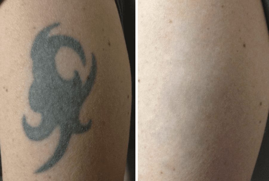 What Makes Enlighten by CUTERA Different from Other Laser Treatments?