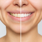 Is Teeth Whitening Worth It?