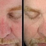 Why Photofacial Treatment in Mississauga is the Upgrade Your Skin’s Been Waiting For?